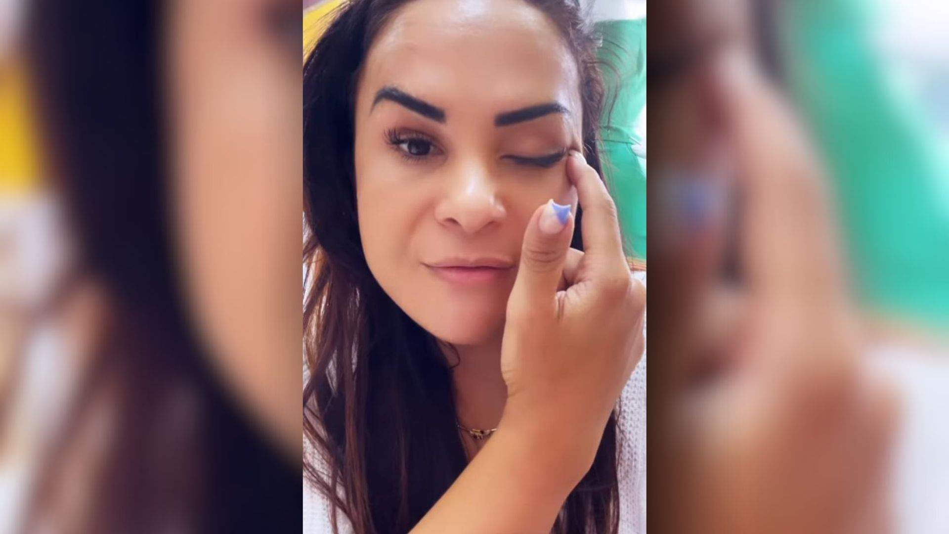 DEU RUIM Empresária de Vila Velha fica olho paralisado após BOTOX