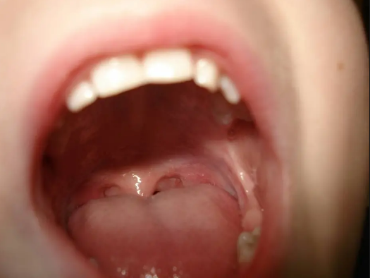 hpv e cancer de boca