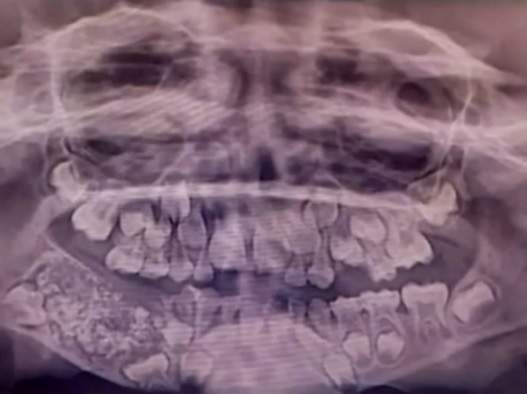 2a408520 96eb 0137 101a 6231c35b6685  minified - Médicos retiram 526 dentes da boca de menino de 7 anos durante cirurgia