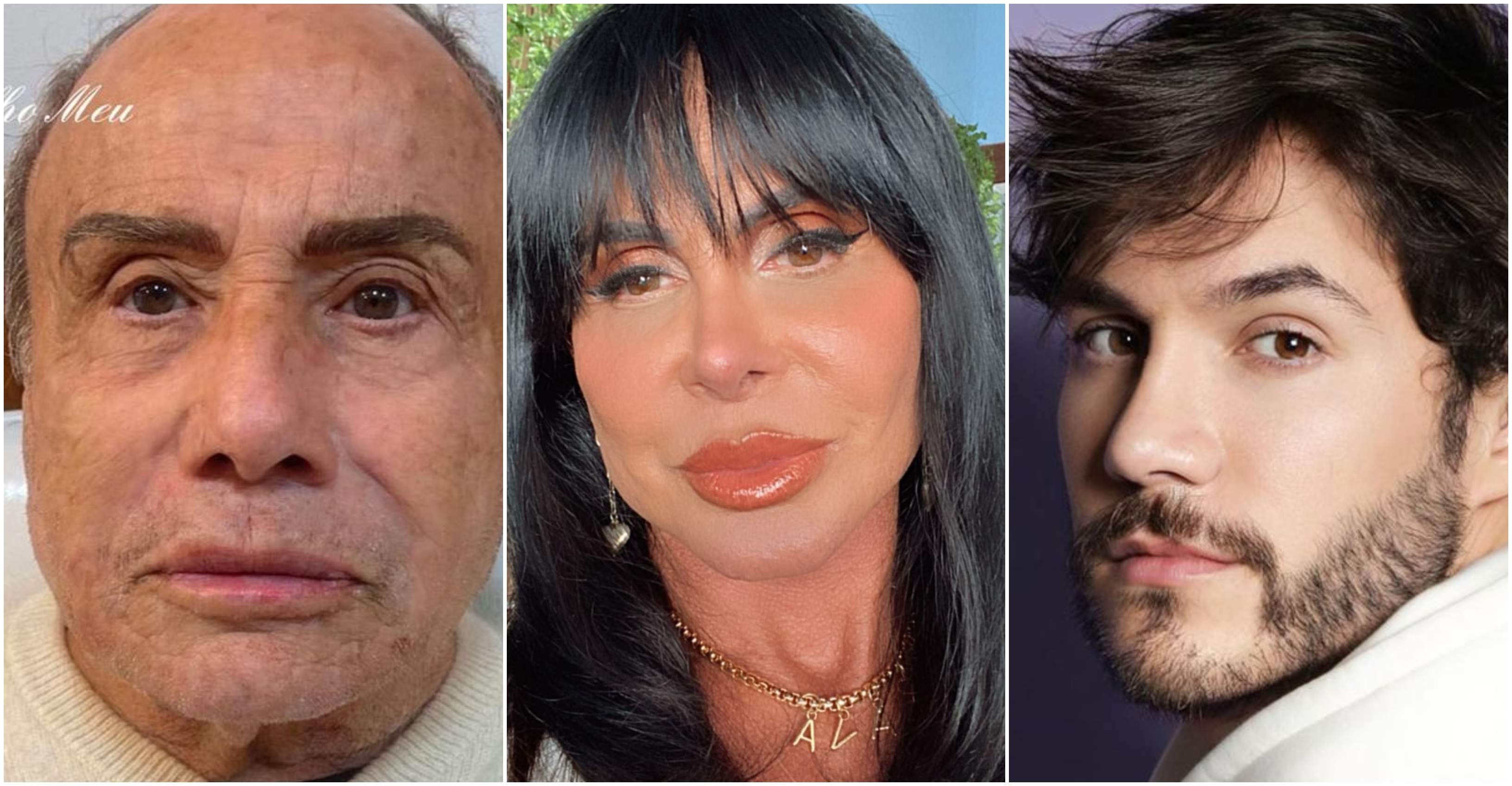 Antes e depois: veja os famosos que fizeram harmonização facial - ISTOÉ  Independente