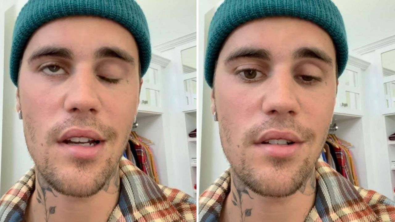 Understand the condition that paralyzed part of Justin Bieber’s face