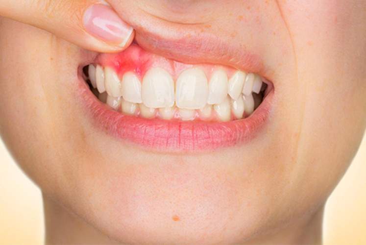 Câncer de boca: um dos tipos mais perigosos e negligenciados